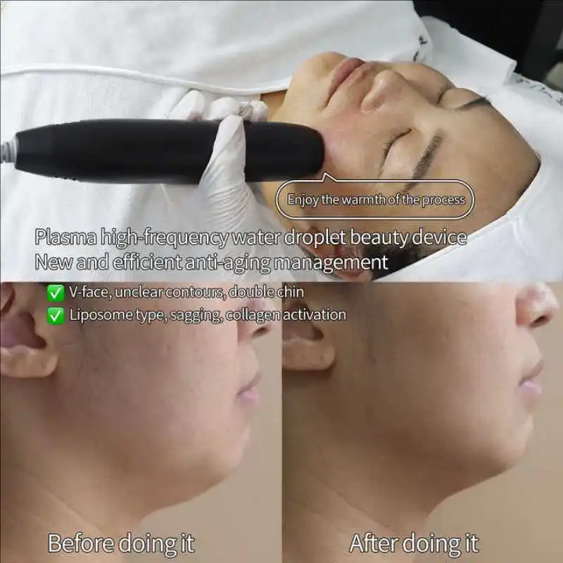 Dispositivo portátil de plasma frío para rejuvenecimiento de la piel, plasma fraccional frío y cálido, plasma de chorro frío para cara