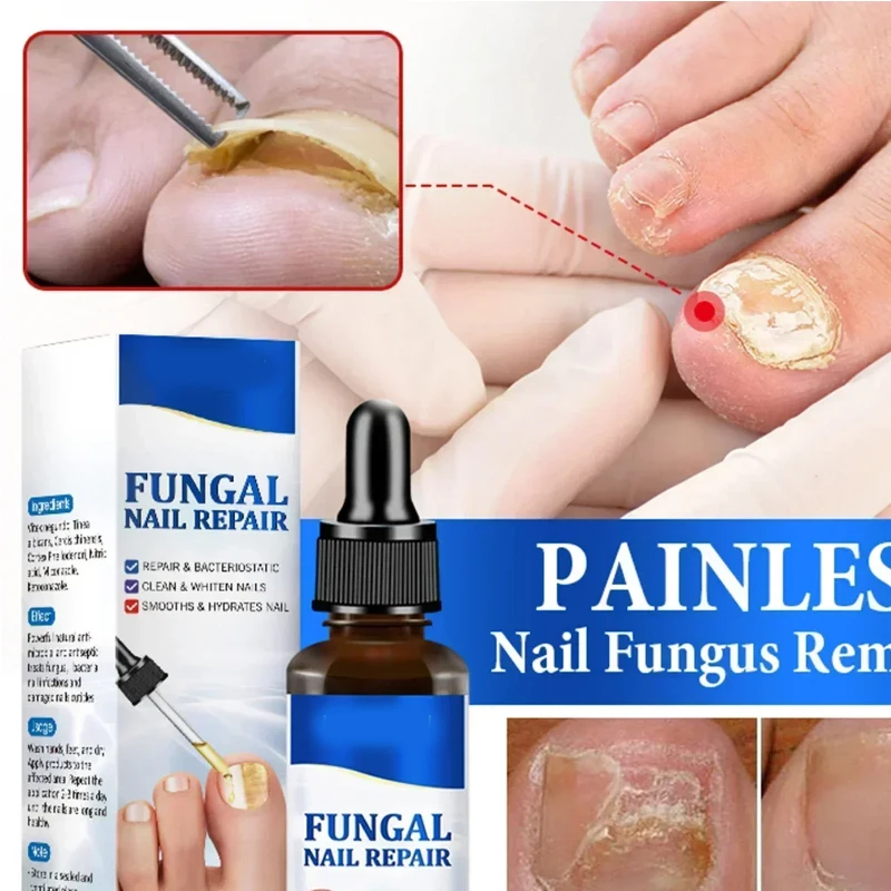 Soro para tratamento de fungos nas unhas, produtos para reparo de fungos dos pés, gel para remoção de cuidados com as mãos e pés, anti-infecção, paroníquia, onicomicose