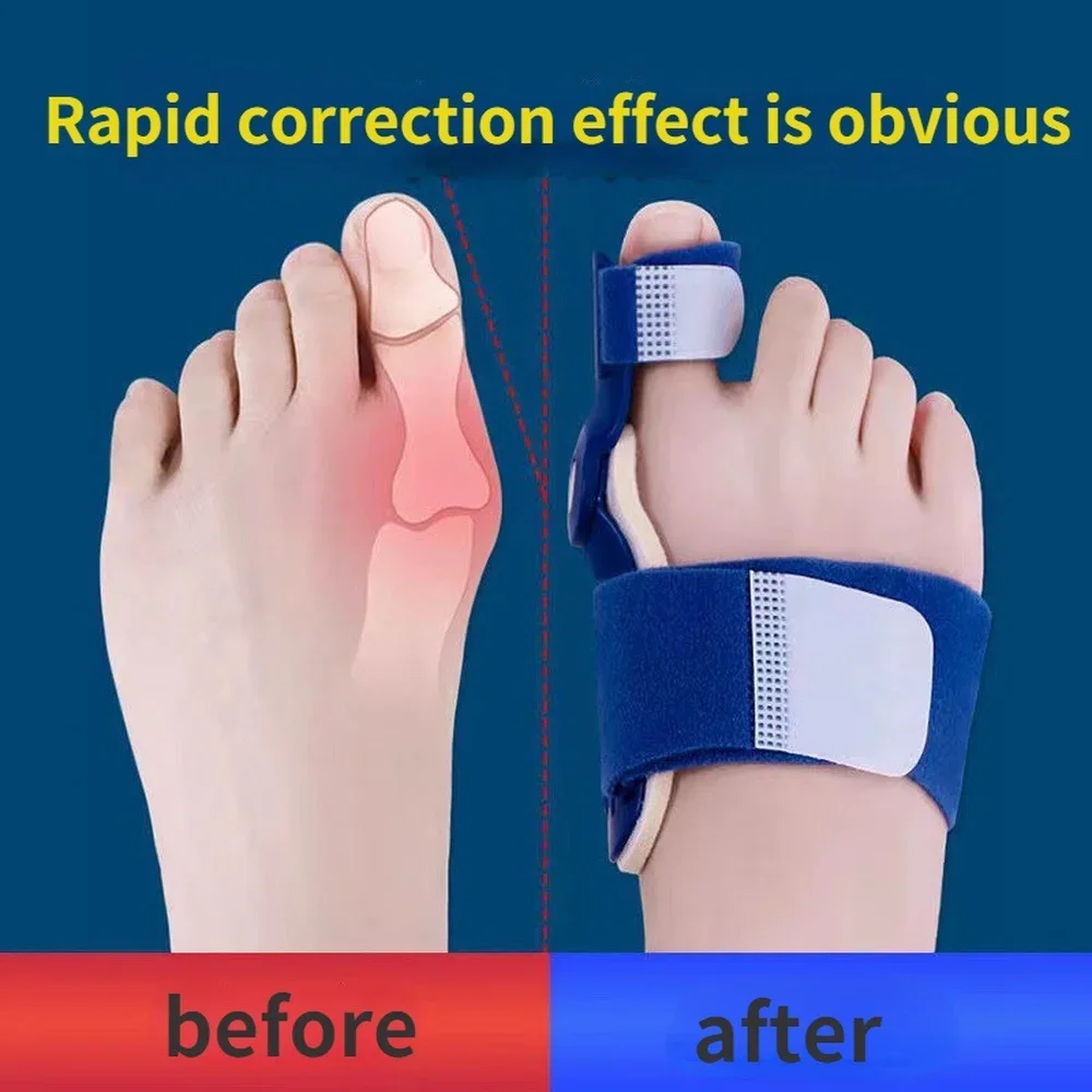 Alisador de férula para juanete, Corrector para aliviar el dolor de pies, Protector para el cuidado de los pies, Hallux Valgus, 1 unidad