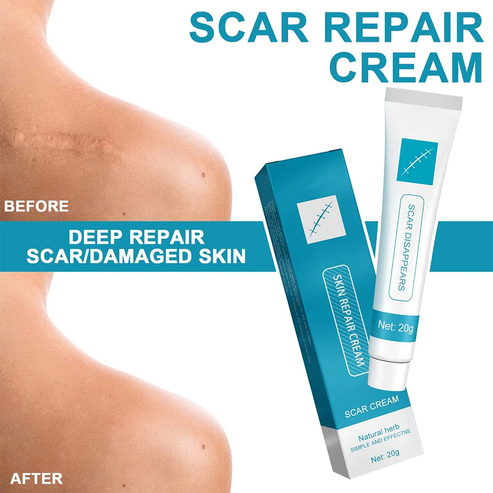 20g Erholung Narben Creme Schnelle Entfernung Haut Narben Behandeln Chirurgie Narben Dehnungsstreifen Akne Pocken Drucke Brennen Reparatur gesichts Pflege Gel