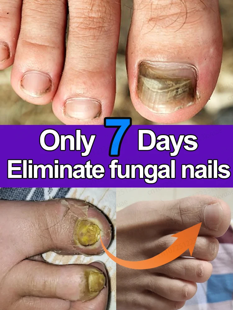 

7 jours de réparation d'huile d'essence d'ongle, produits de soins pour l'onychomycose