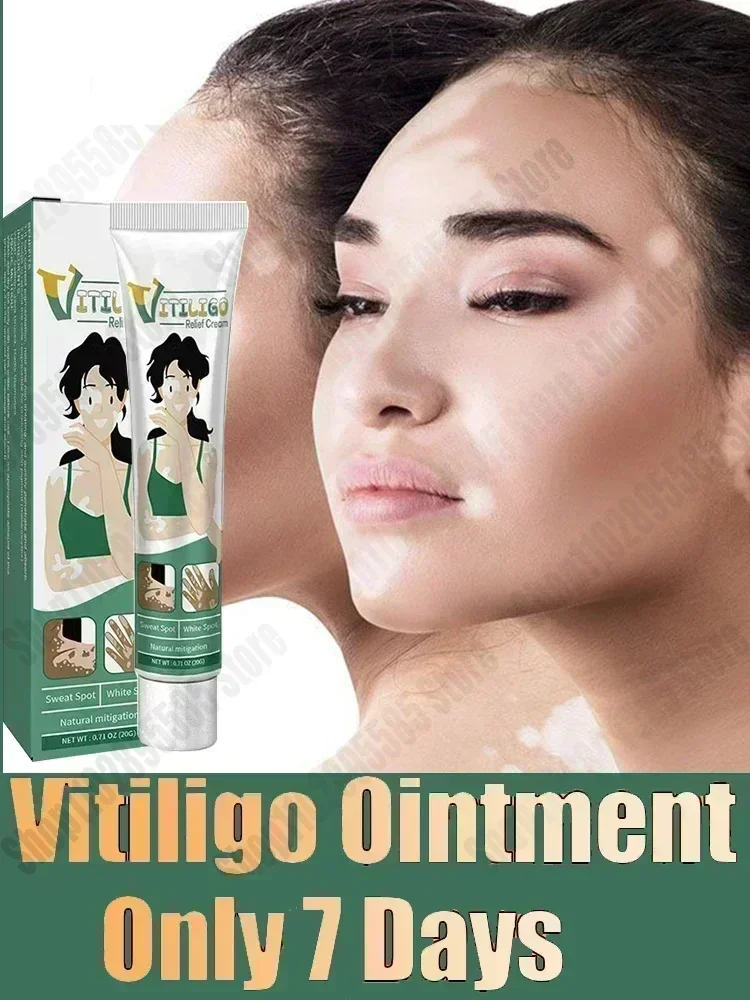 ขายร้อนผู้ขายที่ดีที่สุดจุดสีขาวสําหรับ Vitiligo จุดสีขาว Leukoplakia เมลานินส่งเสริม Vitiligo Skin Care