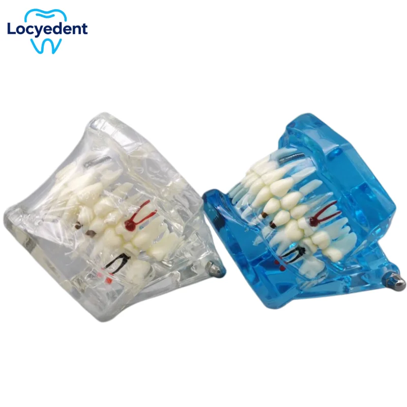 

Dental Implant Teeth Study Model Repairable Resin Model Of Diseased Teeth For Teaching And Research In Medicine Dental Diseases