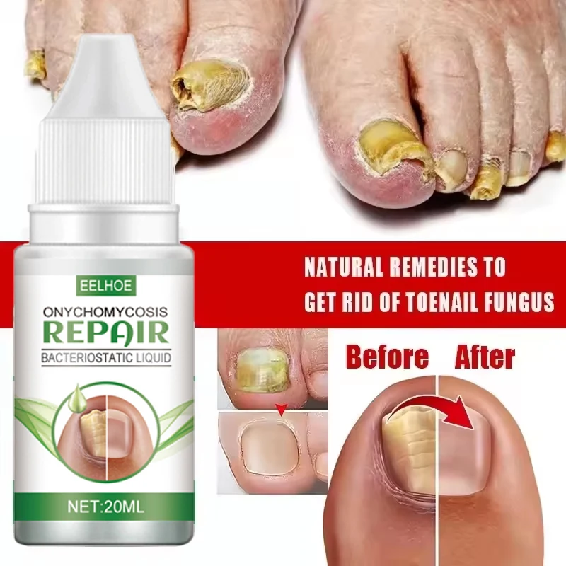 زيت علاج الأظافر الفطرية، إصلاح القدم، جوهر إزالة فطريات الأظافر، كريم مضاد للعدوى، إزالة الأظافر الفطرية