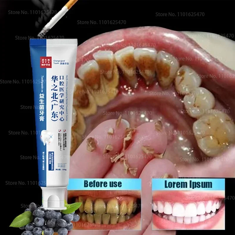 

Quick Repair of Cavities,Caries,Filling, Removal of Plaque,Stains,Decay,Yellowing Repair Teeth Whitening,Blanchiment Des Dents