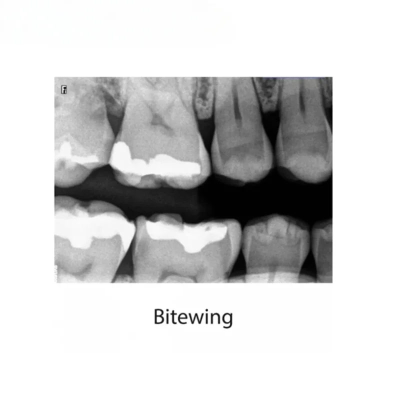LK-C64 Carestream RVG5200 مستشعر الأشعة السينية الرقمي