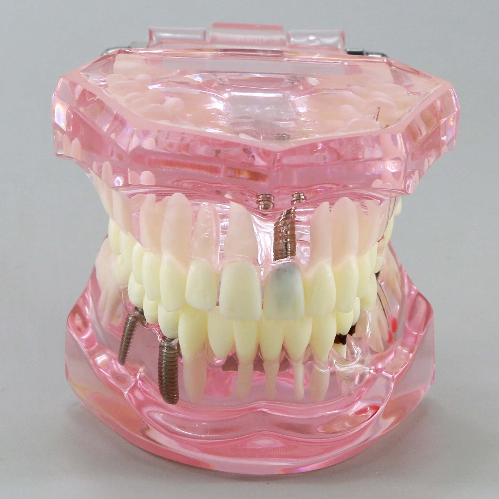 Dental Teeth Model Teaching Model Implant Disease Teeth Repair Restoration Bridge for Dentist Teaching Studying Demo M2001 Pink.