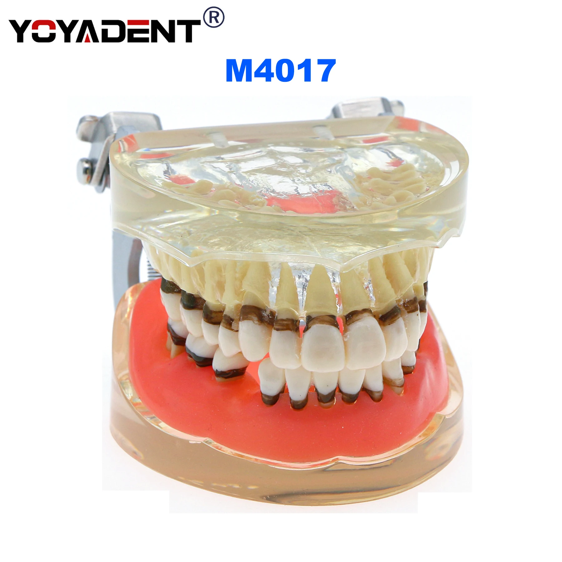 Dental Teeth Model Dental Periodontal Disease Gingivas Recession Dentists Teaching Model Demonstration