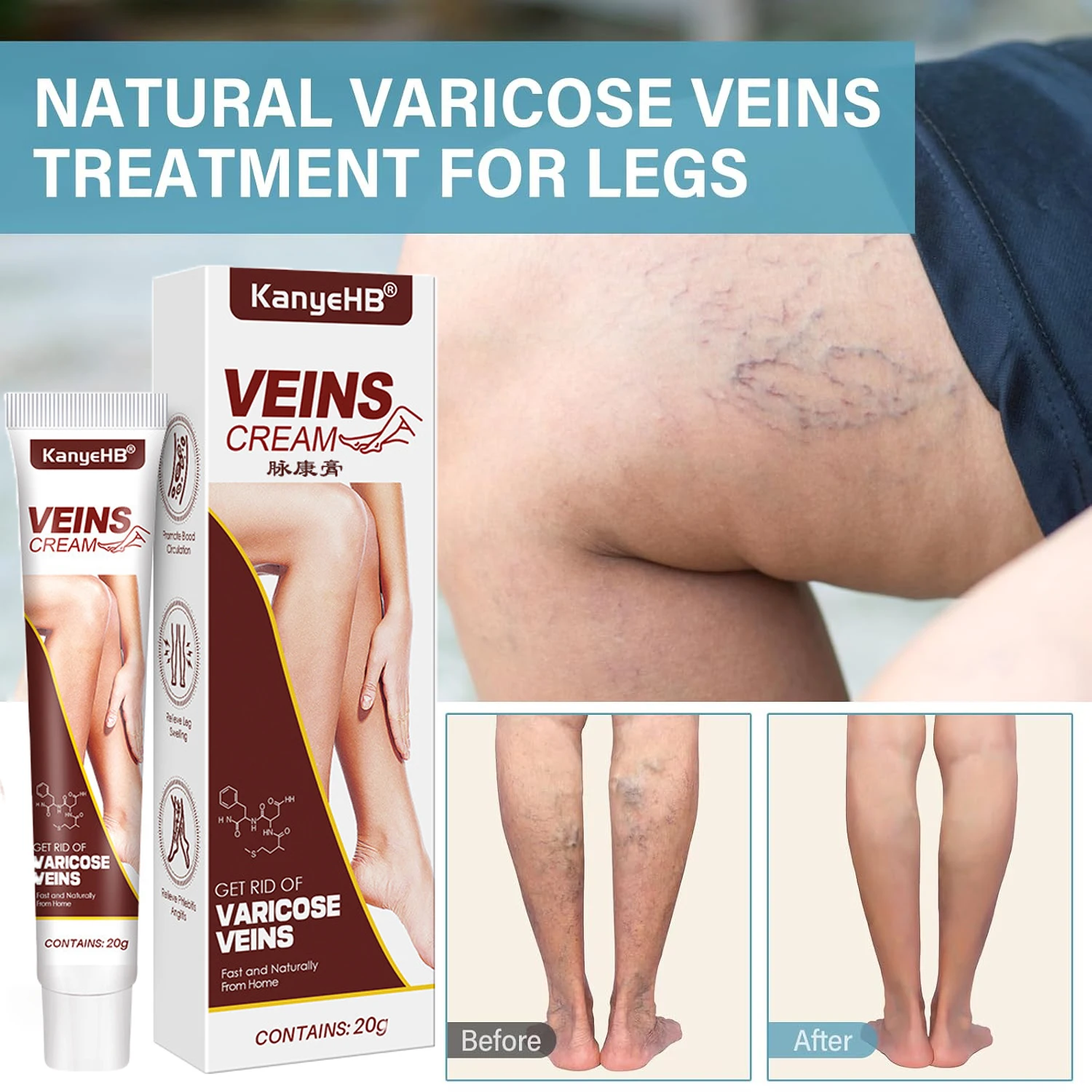 

1/5/10 PCS Feet Varicose Veins Creams Treatment Relieve Capillaries Dilate Effective Nursing Treatment Spider Leg Beauty Cream