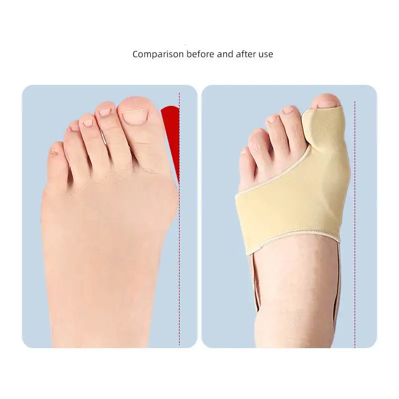 1Pair Hallux Valgus Foot Sleeve Orthosis High-elastic Nylon Day and Night Toe Separator Built-in Gel Pads and Elastic Heel Strap