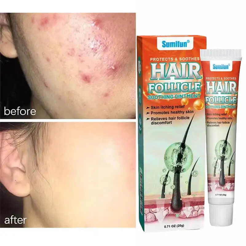 Body Acne Removal Cream Treatment Face Butt Back Acne Marks Smooth Repair Chicken Skin Cream Moisturizing Whitening Skin Care