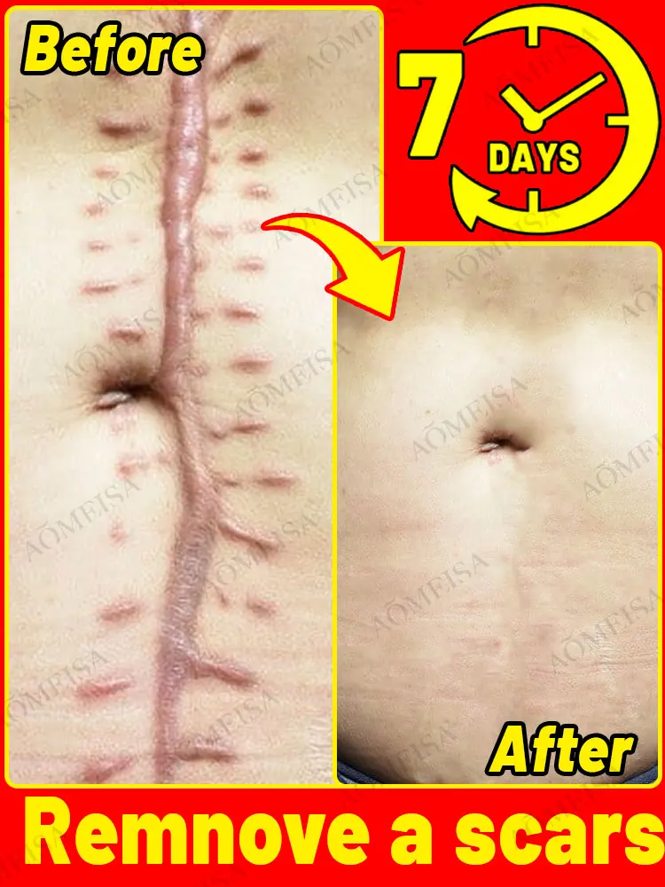 

Scar removal products, remove scars, stretch marks, surgical scars in 7 days