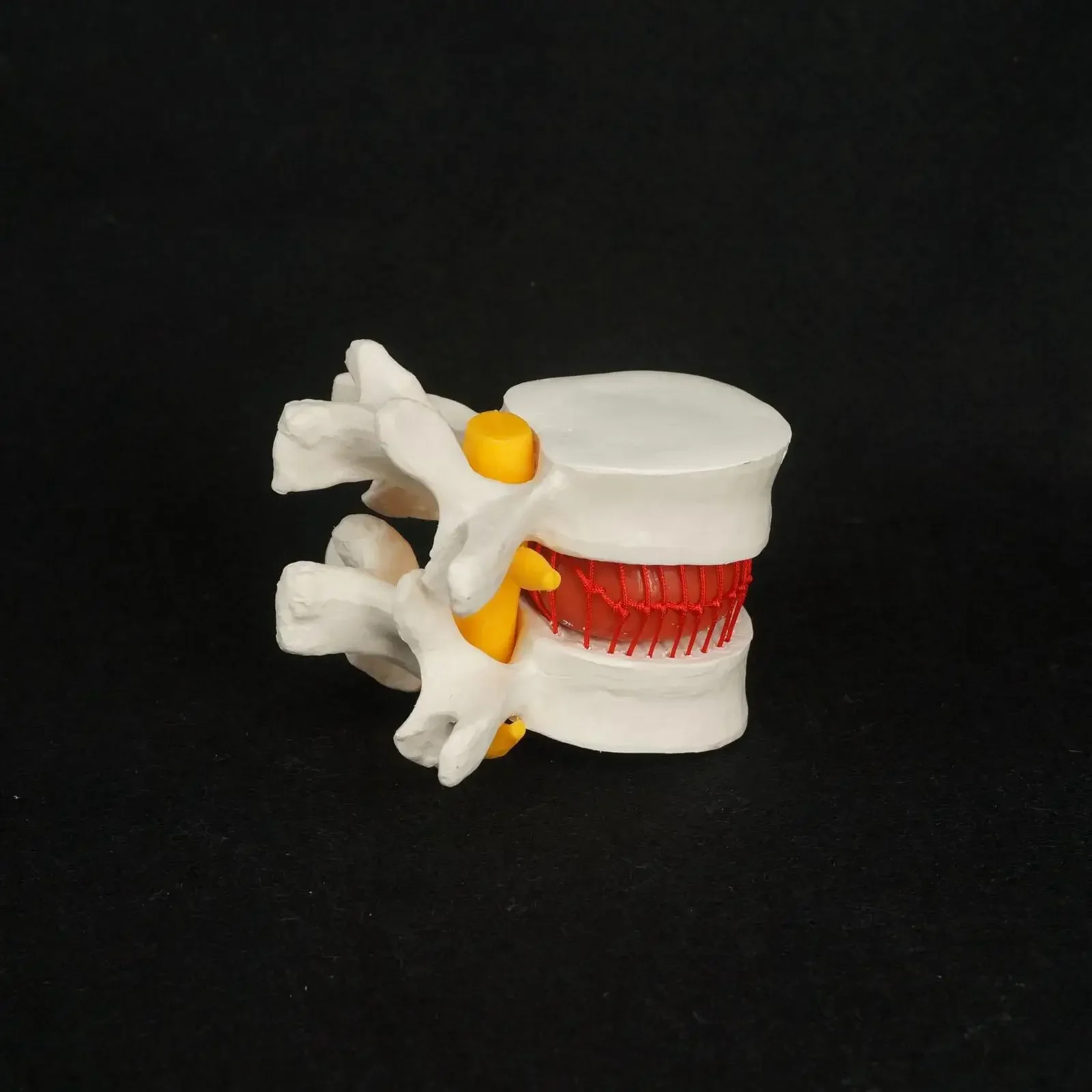 Modelo de prolapso de disco de vértebras lumbares hernia anatómica de PVC anatomía médica humana