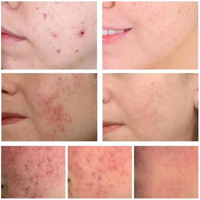 Salicylic Acid Acne Cream Fast Gently Repair Acne Spot Scar Shrinks Pores Gel Brightens Skin Tone Tightens Skin Korean Skincare