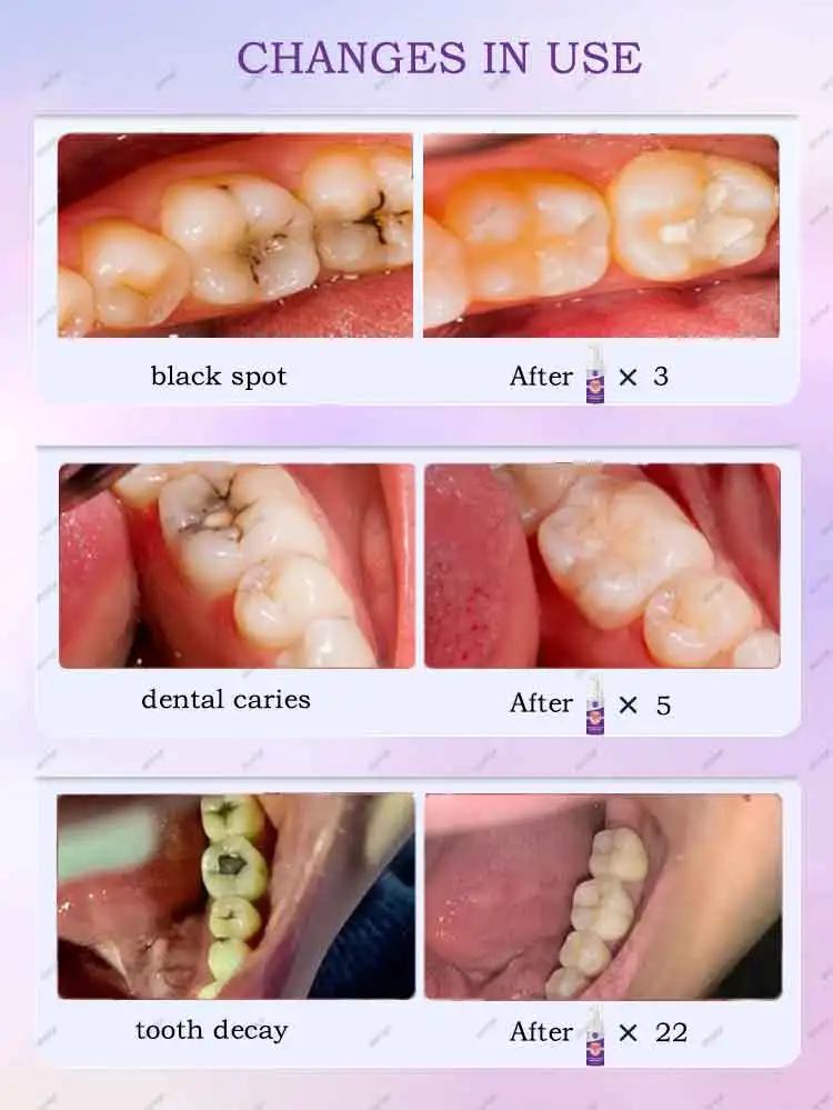 Decay tooth Cavities healing anti caries