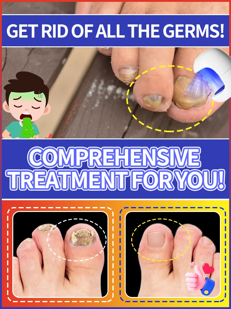 

Blue light device Solve Toenails problems