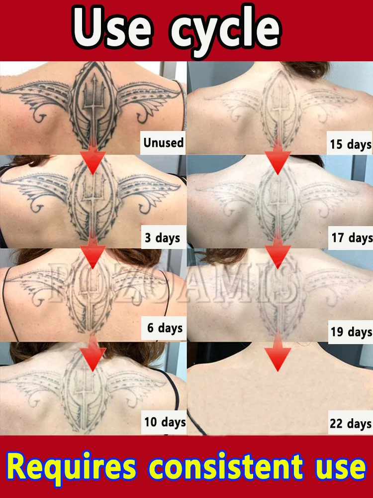 あらゆるサイズ、形、デザインのタトゥーを迅速に除去します。
