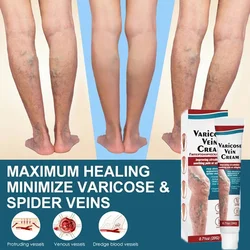 Powerful Varicose Vein Relief Cream to Eliminate Vasculitis Phlebitis Spider and Soothe Muscle Pain