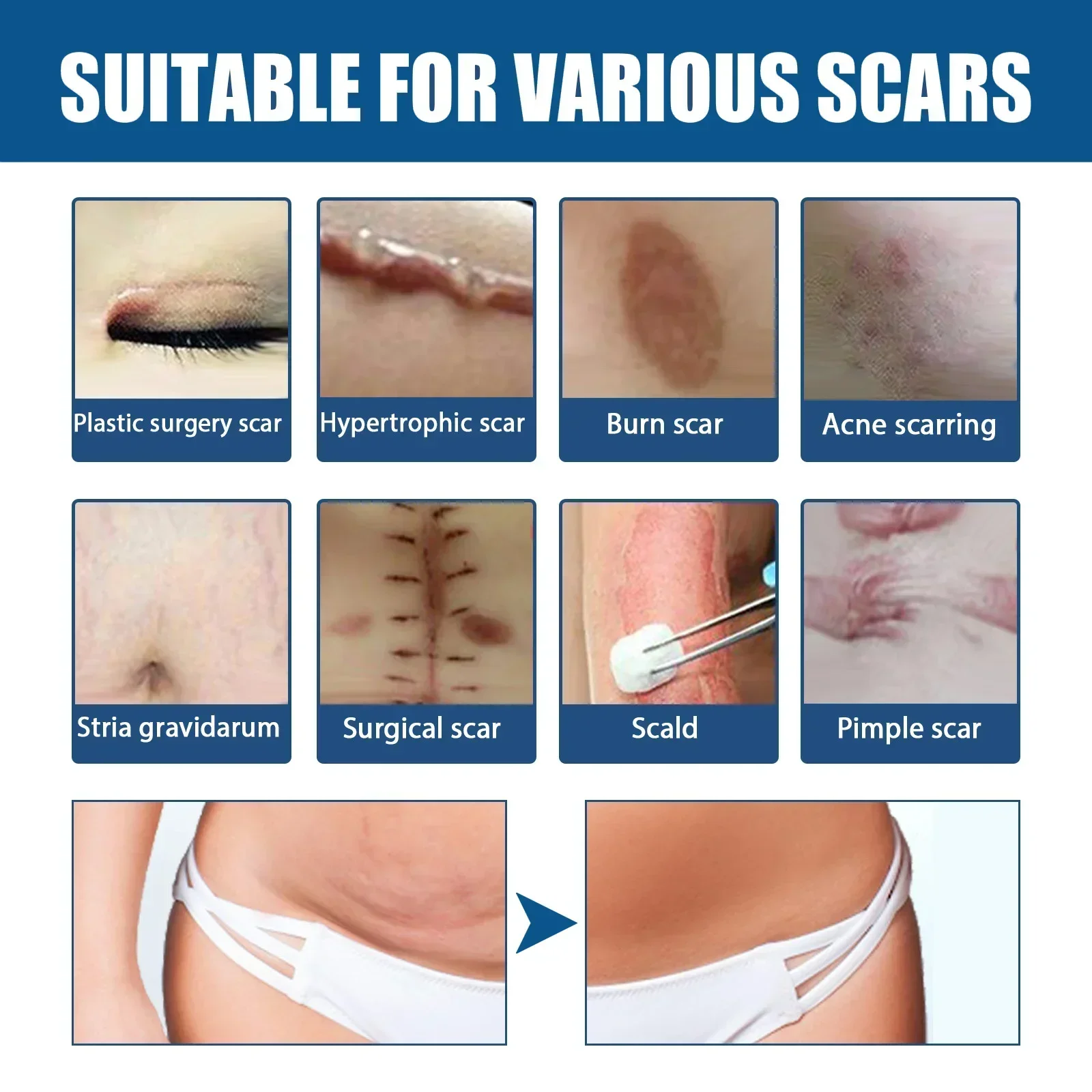 Recovery Scar Cream Fast Removal Skin Scars Treat Surgery Scars Stretch Marks Acne Pox Prints Burn Repair Facial Care