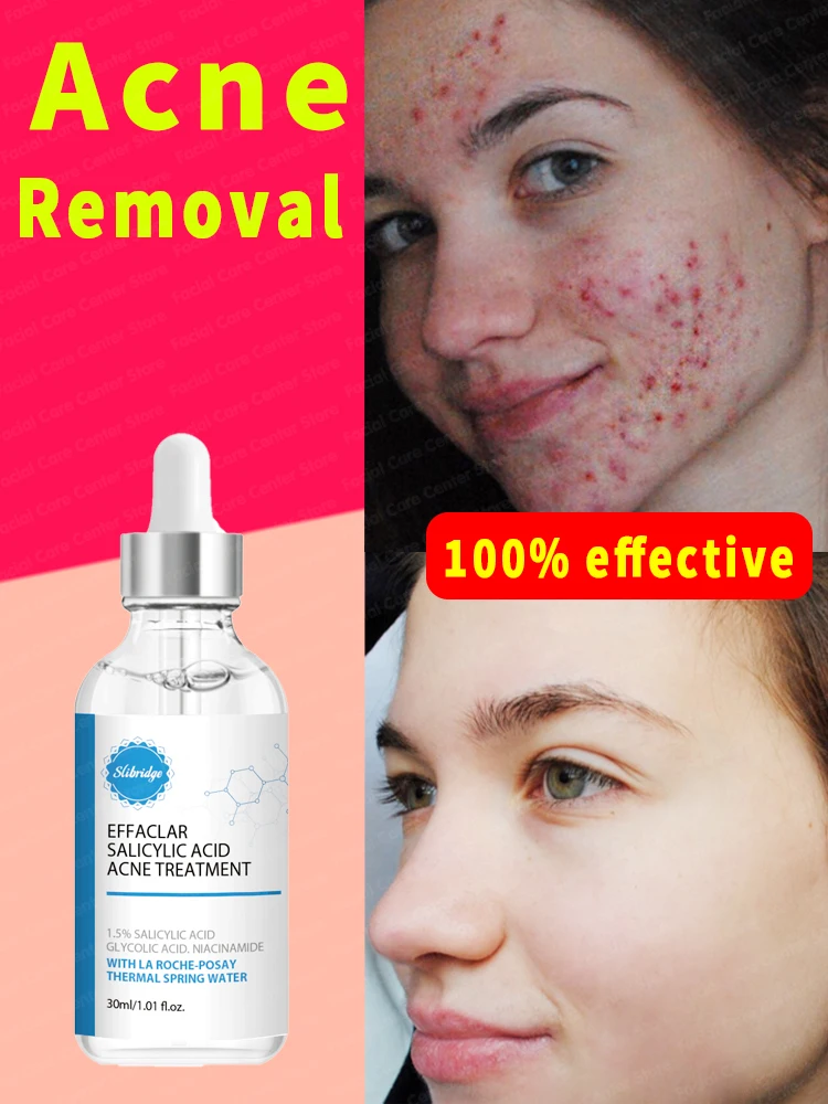 

remove acne scars face marks remedy pimple remedy