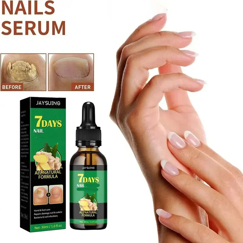 Nail 𝐅𝐮𝐧𝐠𝐮𝐬 𝐓𝐫𝐞𝐚𝐭𝐦𝐞𝐧𝐭 𝐎𝐧𝐲𝐜𝐡𝐨𝐦𝐲𝐜𝐨𝐬𝐢𝐬 𝐑𝐞𝐩𝐚𝐢𝐫 Herbaceous Essential oil For 𝐏𝐚𝐫𝐨𝐧𝐲𝐜𝐡𝐢𝐚