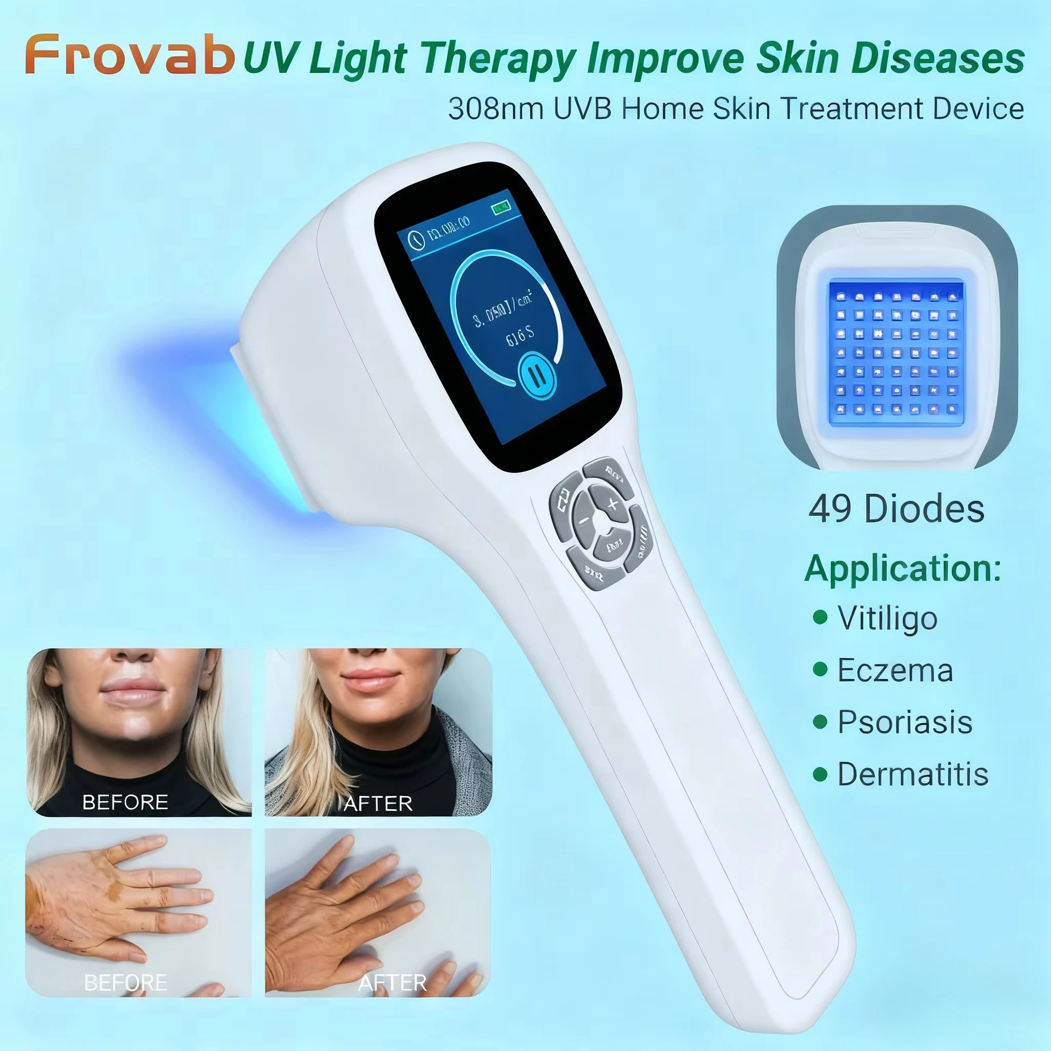 

49 диодов 308 нм UVB светотерапевтический аппарат портативная лампа для фототерапии для псориаза, витилиго, экземы, ультрафиолетовое устройство для домашнего использования