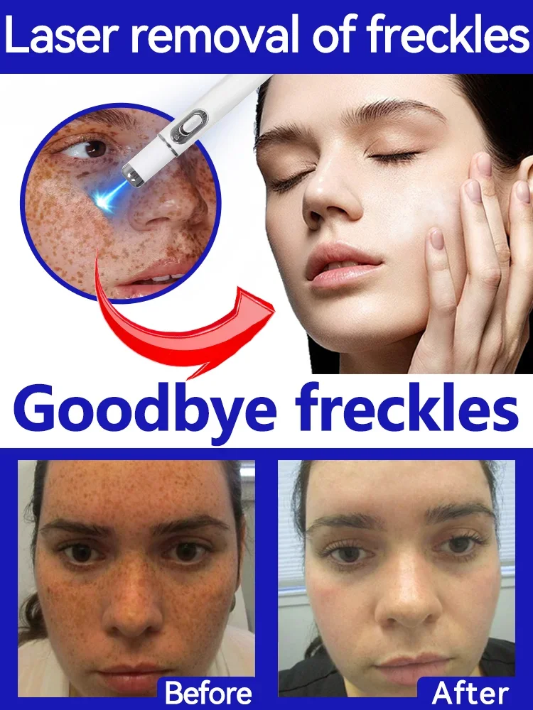 Laser Quick Repair of Facial Freckles