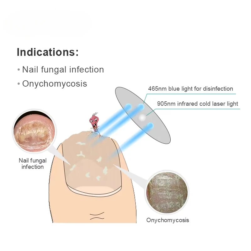 Lottomr 로우 레벨 Lottomr 테라피 블루 라이트 LED 네일 곰팡이, 발톱 진균증 치료 기구, 905nm llt