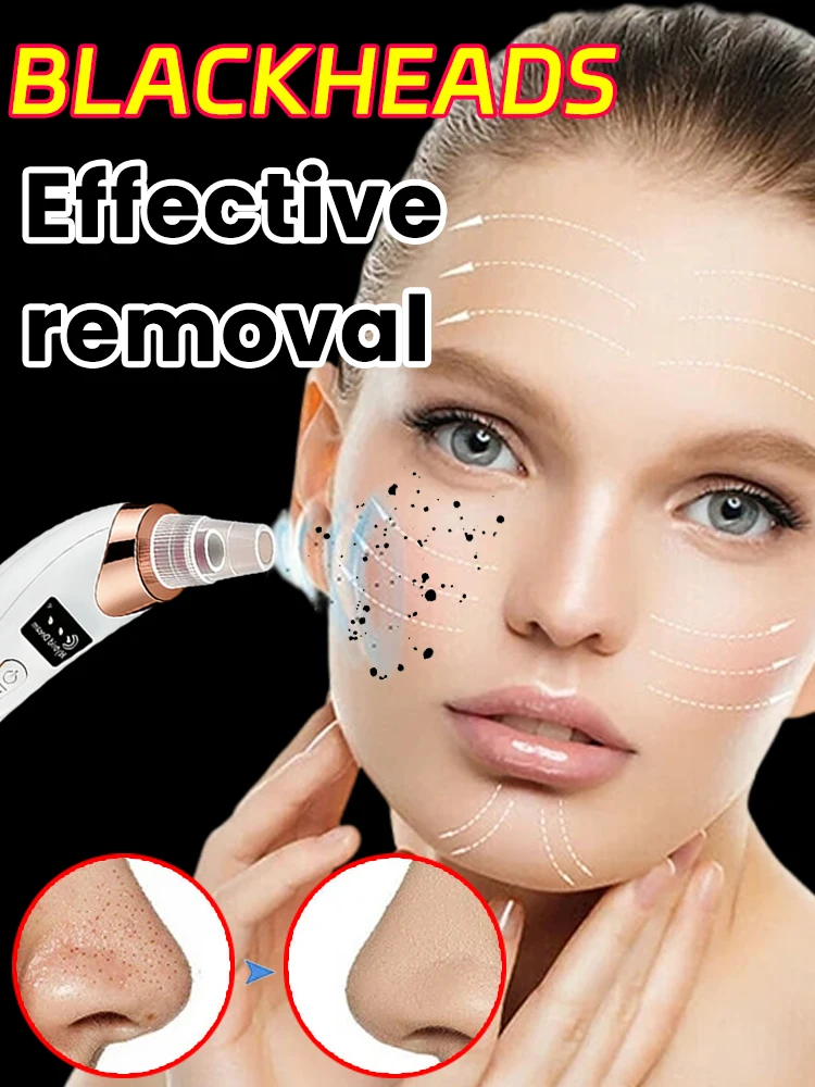 

Вакуумный очиститель пор для ухода за кожей лица, удаление черных точек, глубокая очистка пор, 5 уровней мощности всасывания, средство для удаления черных точек.