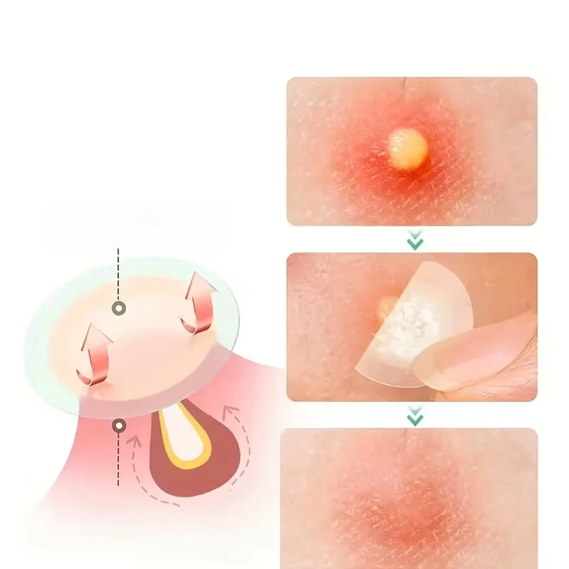 12/24/48 Hitwalker acne patches, hydrogel patches, 24-hour protection, invisible coverage, non irritating, suitable for sensitiv image 3