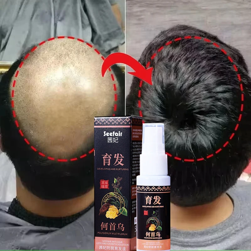 

Health Hair Growth Serum Spray Anti Loss Regrowth Hair Growth Oil Essence Scalp Massage Moisturizing Nourish Hair Care Men Women
