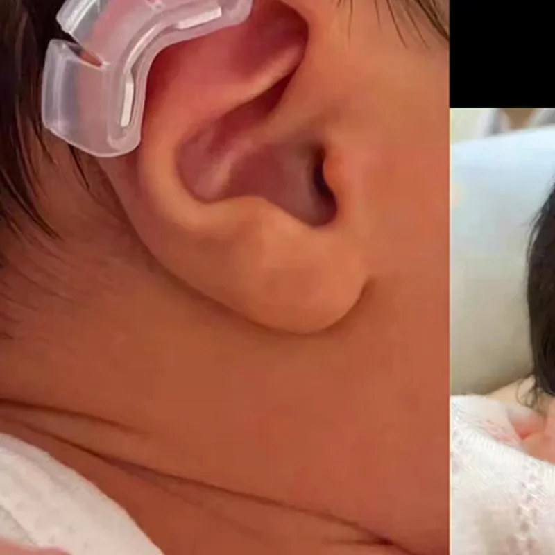 1 قطعة الطفل الأذن دعم الخارجي الأذن مصحح جاحظ الطفل الأذن مصحح الطفل الخارجي الأذن مصحح بطانة للأذن