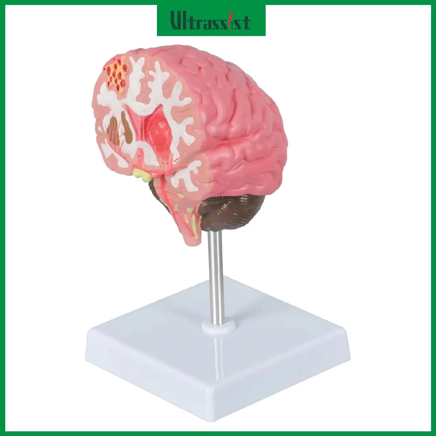 

Ultrassist Human Brain Stroke Anatomy Model Life-Size Structure Anatomical Cerebral Hemorrhage Pathological for Medical Educate