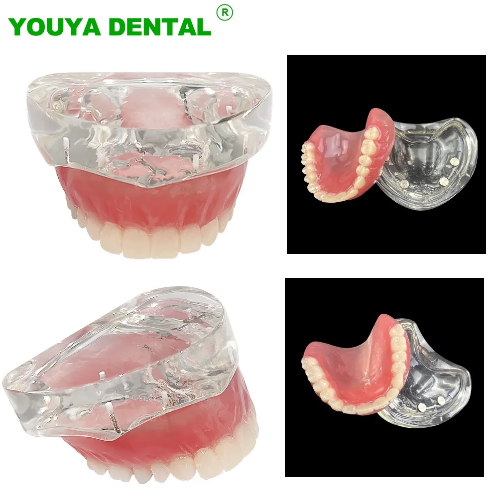 Dental Implant Model Dentistry Upper Overdenture Superior Demo Model Removable Bridge 4 Implants Restoration Demonstration Model