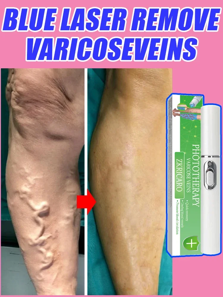 

Best Selling Varicose Vein Laser