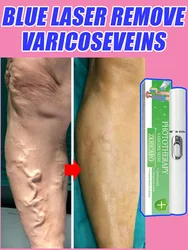 Best Selling Varicose Vein Laser