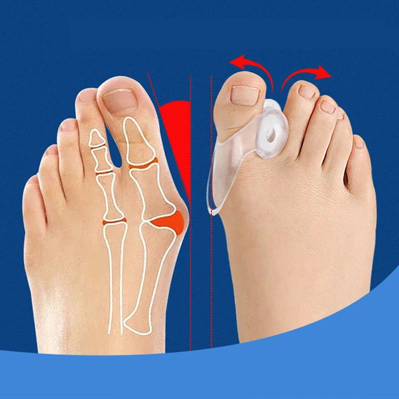 1 paio di correttore per pollice in Gel di Silicone Bunion Foot Toe Hallux valgo Protector separatore raddrizzatore per le dita strumento per la cura del piede