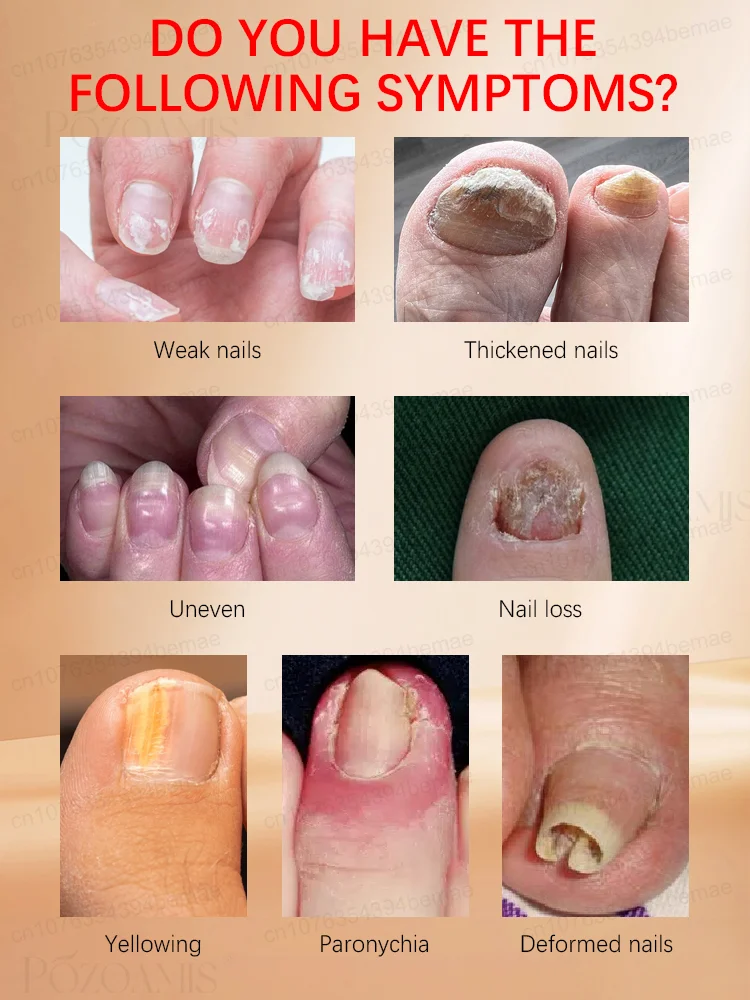 The most powerful black technology in 2025,ᵉᶠᶠᵉᶜᵗⁱᵛᵉ ⁿᵃⁱˡ ᶠᵘⁿᵍᵘˢ ᵗʳᵉᵃᵗᵐᵉⁿᵗ⸴ ʳᵉˢᵗᵒʳᵉ ⁿᵃⁱˡ ʰᵉᵃˡᵗʰ ⁱⁿ ⁷ ᵈᵃʸˢ