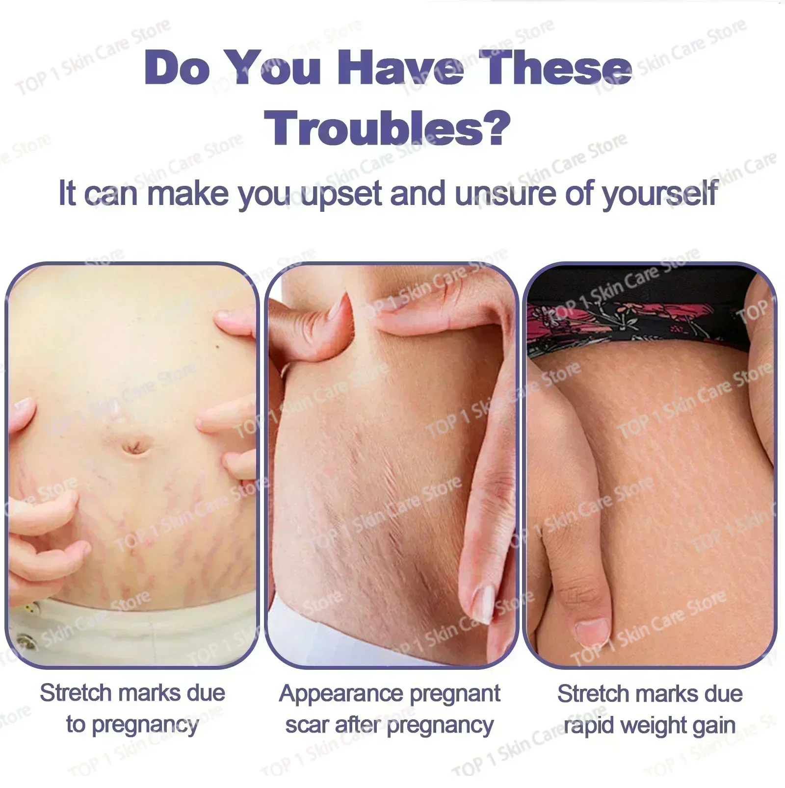 Stretch Marks Remover  Pregnancy Maternity Body New Old Stretch Remove Marks Lifting Firming Increase Elasticity Of Skin 1006