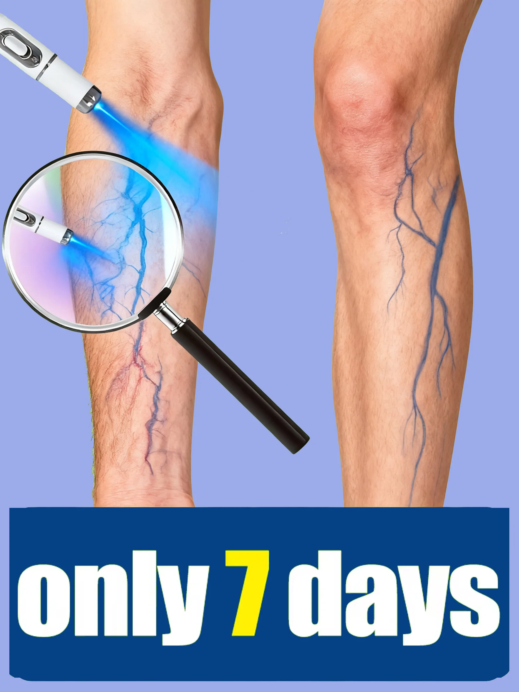 

Многофункциональное поколение унисекс, 2023 г., 2 варианта лазера «Прощай на паучьи ноги», варикозное расширение в течение 7 дней