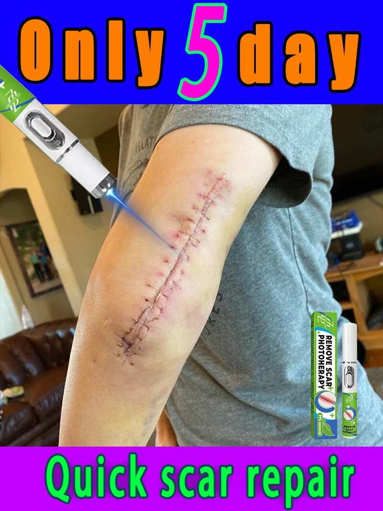 Rᴇᴘᴀɪʀ ᴀʟʟ ʏᴏᴜʀ sᴄᴀʀs ɪɴ 5 ᴅᴀʏs ᴡɪᴛʜᴏᴜᴛ ʀᴇᴄᴜʀʀᴇɴᴄᴇ, sᴀғᴇ ᴀɴᴅ ᴇғғᴇᴄᴛɪᴠᴇ sᴄᴀʀ ʀᴇᴍᴏᴠᴀʟ ʟᴀsᴇʀ ᴘᴇɴ