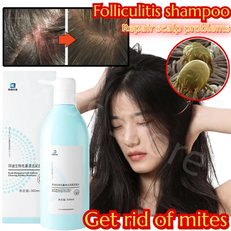 

Folliculitis Cleansing and Moisturizing Shampoo Anti-Dandruff Anti-Itching Oil Control Cleansing Scalp Shampoo Repairs The Scalp