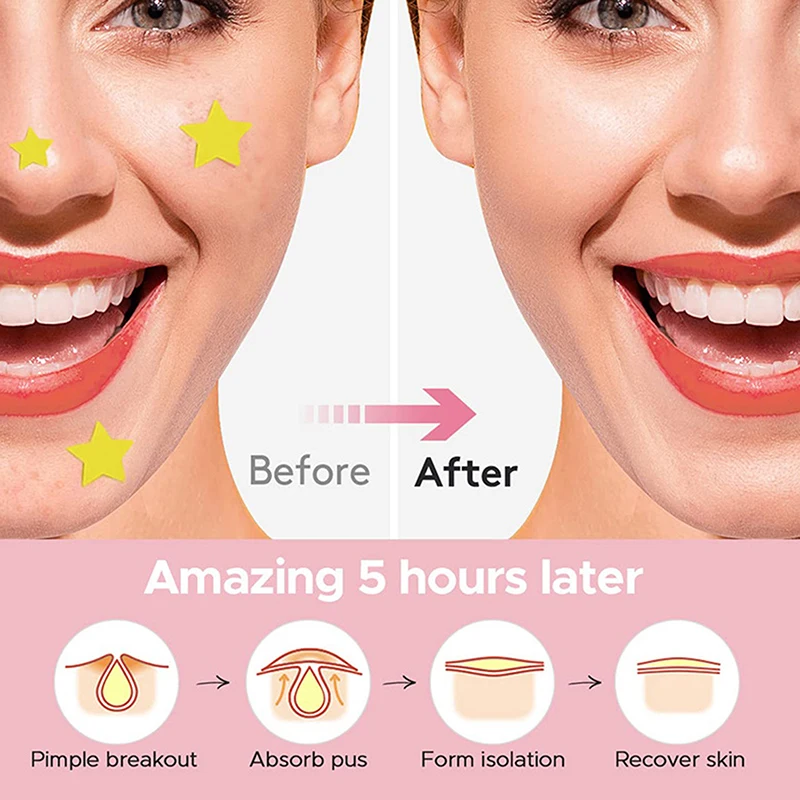 112PCS/SET Pimple P… - image