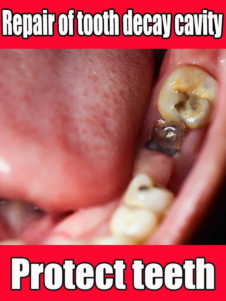 Tooth Decay Repair Repair All Tooth Decay Cavities and Protect Teeth Whitening Teeth Dental Lab Dental Caries Decayed Teeth