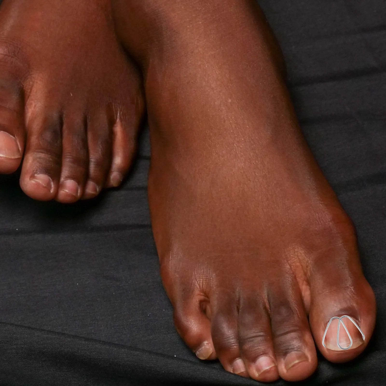 

12Pcs Nail Groove Corrector Stainless Steel Toenail Care Tool for Ingrown Toenail Correction Lightweight Portable Foot Pedicure