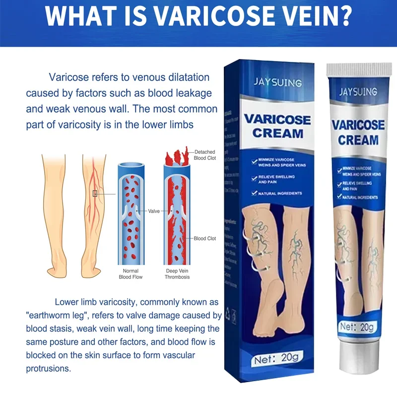 Laser Pen Lampshade Tool Varicose Veins Cream Remove Red Blood Streak Varicocele Vasculitis Phlebitis Strengthen Capillary