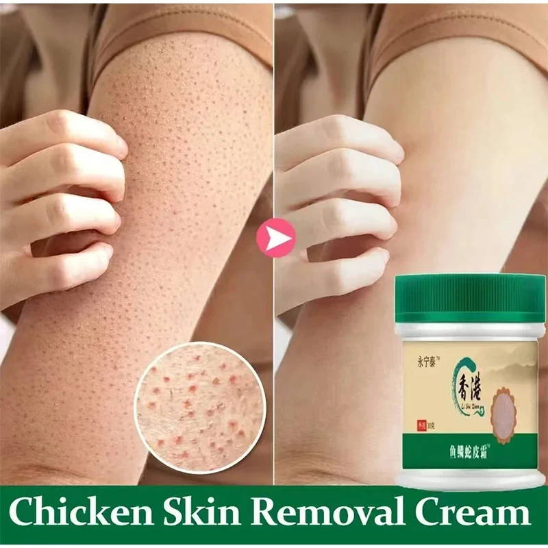 Frango Pele Remoção Body Care Cream, Diluir e remover células mortas da pele, Pore Spot, Clareamento maçante, Hidratante