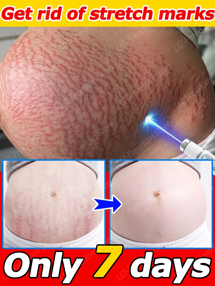 

Stretch Mark Cream Reduces Scar