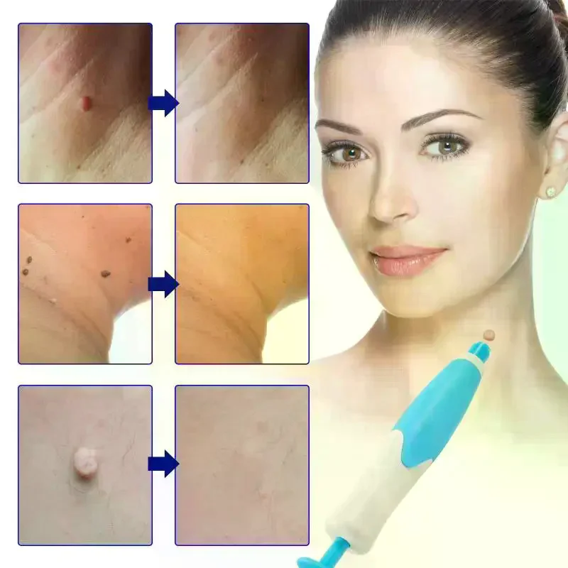 Double Headed Wart Removing Pen Set Auto Skin Tag Remover Painless Mole Wart Remover Skin Tag Removal Kit Skin Care Beauty Tool