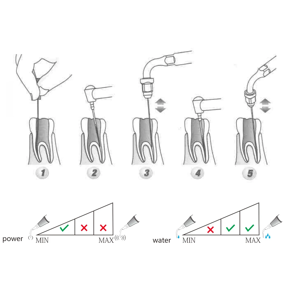 Punta de escarificador Dental ED1 ED2, punta de endodoncia para odontología, compatible con Scaler ultrasónico SATELEC/DTE para herramientas de limpieza de Canal radicular Anterior